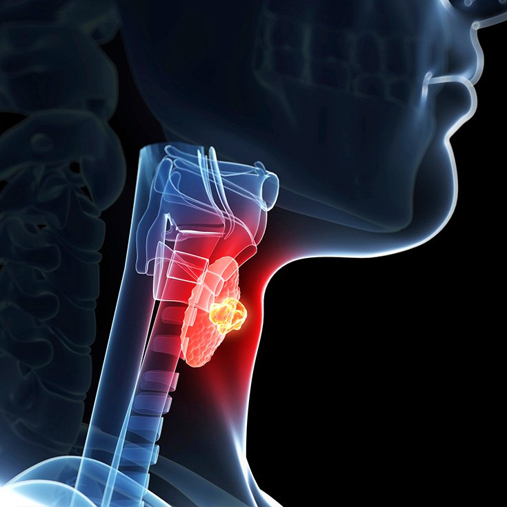 Tiroiditis Subaguda: Causas, Síntomas, Tratamiento   La Guía de las Vitaminas